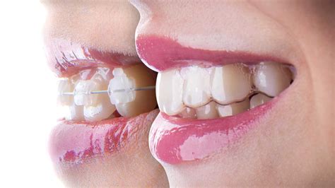 Teeth Aligners vs. Clear Braces: What’s the Difference?