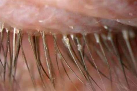 Over 100 Eye Parasites Caused This Womans Eye Itching And Redness