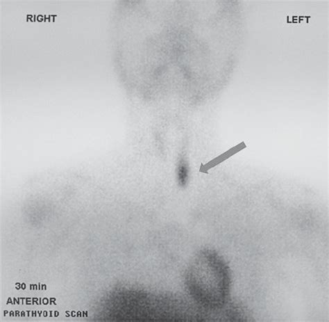 M Tc Sestamibi Parathyroid Scan Showing Left Inferior Parathyroid