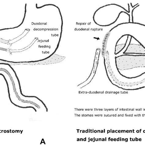 Case 7 Placement Of Duodenal Decompression Tube And Jejunal Feeding Download Scientific