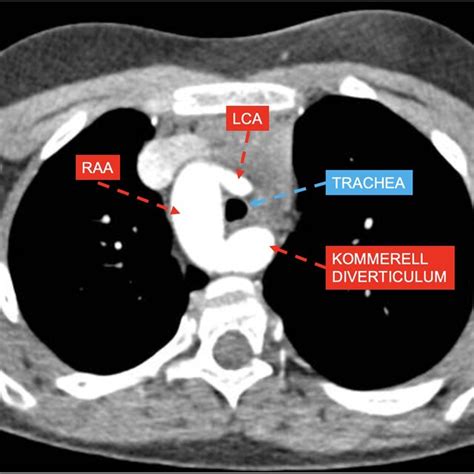 Ct Axial View Showing Right Aortic Arch Raa With Aberrant Left