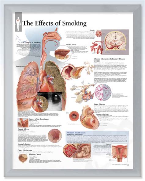 Effects of Smoking Exam-Room Anatomy Poster – clinicalposters.com