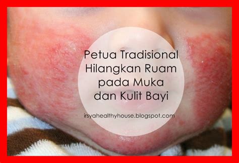 4 Petua Tradisional Hilangkan Ruam Pada Muka Dan Kulit Bayi Dekat