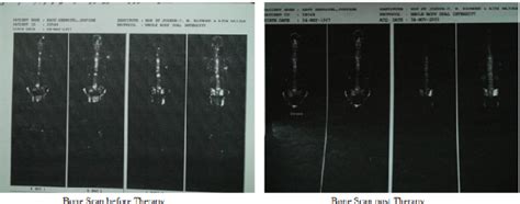 Figure From A Phase Ii Trial In Advanced And Metastatic Breast Cancer