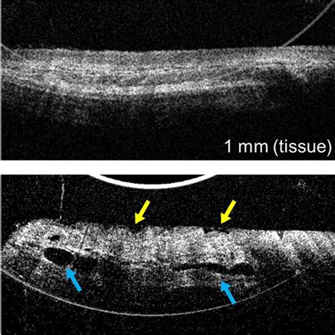 OCT Cross Sectional Images Of Esophageal Epithelium Acquired By Probe