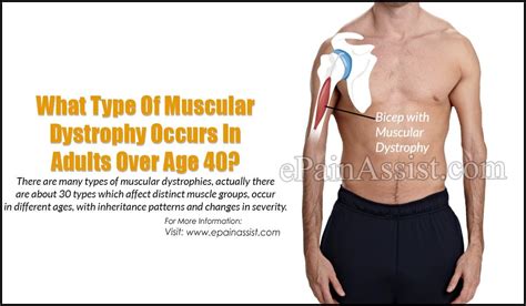 Muscular Dystrophy Types Chart