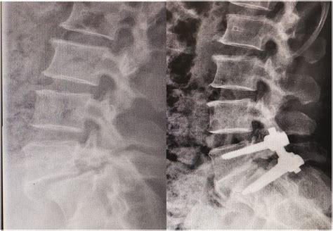 Preoperative Left And Postoperative Right X Rays Of Lumbar