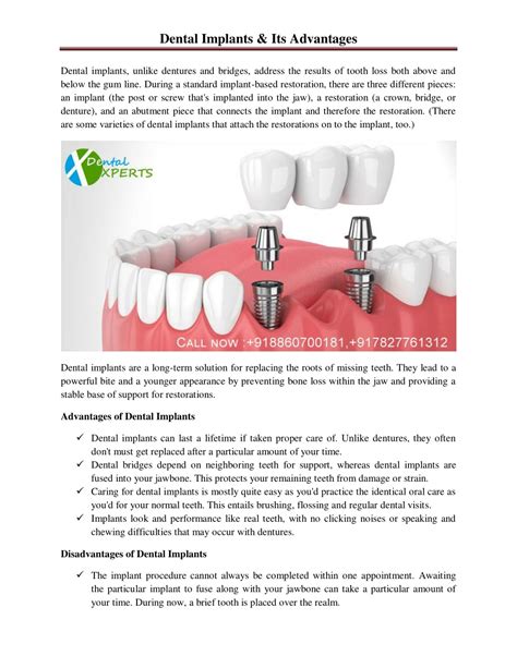 PPT Dental Implants Its Advantages PowerPoint Presentation Free