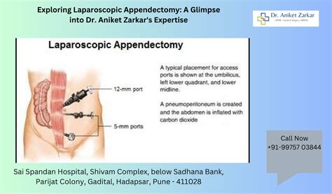 Exploring Laparoscopic Appendectomy