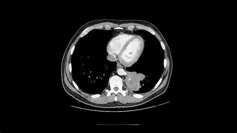 Pulmonary Sequestration - StoryMD