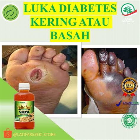 Jual Obat Luka Bakar Diabetes Kering Basah Koreng Gatal Jerawat Batu