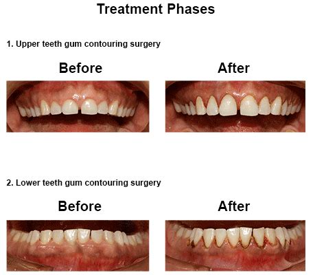 Gingivoplasty in Cosmetic Dentistry | Smiles Peru