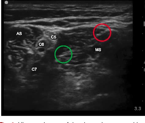 Figure From Risk Of Encountering Dorsal Scapular And Long Thoracic