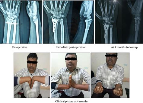 Figure 2 From A Prospective Study On Clinical And Functional Outcome Of