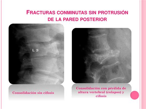 Im Genes De Fracturas Conminutas