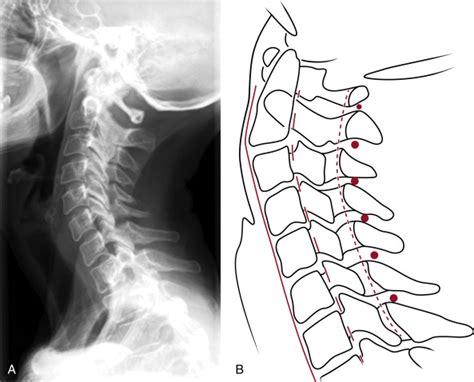 The Cervical Spine Radiology Key