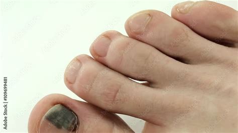 Wideo Stock Subungual Hematoma Bruise Under The Nail Of Big Toe