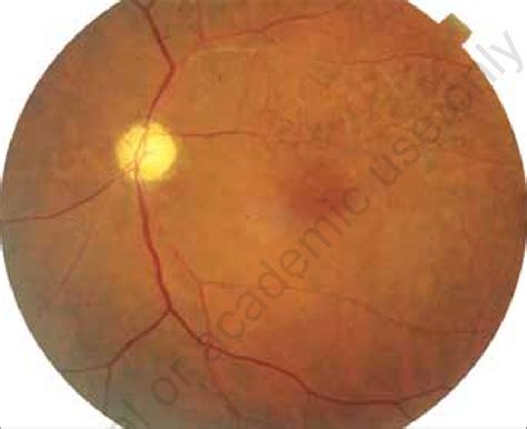 Color Fundus Photograph Of The Left Eye Shows Optic Disc Atrophy