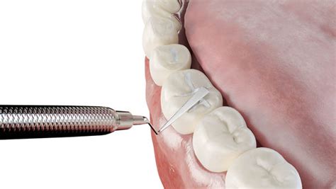 How A Dental Filling Is Used For A Cavity Metro Smiles Dental Forest