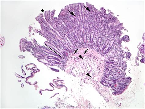 This Duodenal Biopsy Shows Few Preserved Short Villi Asterisk