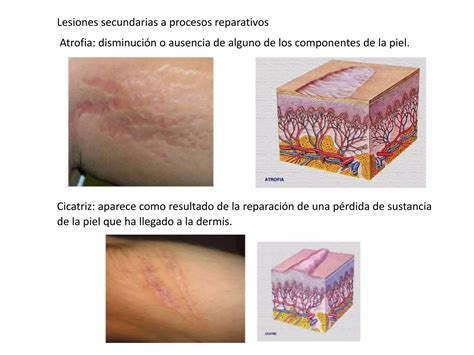 Lesiones Cut Neas Primarias Y Secundarias Pptx