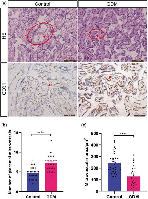 Pathological Changes In The Placenta Of GDM Patients A HE Staining