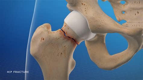 Hip Fracture