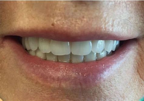 Smile Gallery Before And After Dentures In Surrey Bc