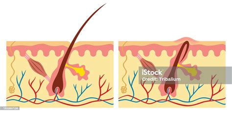 자란 및 일반 모발 모낭에 대한 스톡 벡터 아트 및 기타 이미지 모낭 여러 층 염증 Istock