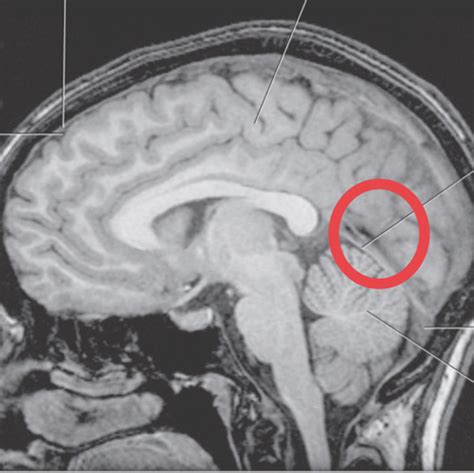 Sectional Anatomy Brain Week 3 Flashcards Quizlet