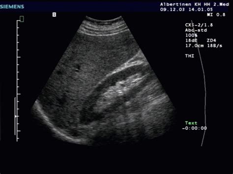 Steatosis hepatis - DocCheck