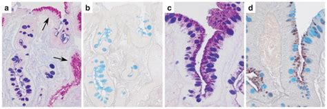 Pathology Of Gastric Intestinal Metaplasia Clinical Implications Pmc