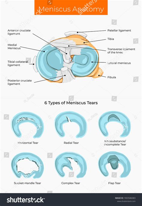 Vector Illustration Meniscus Anatomy And Royalty Free Stock Vector