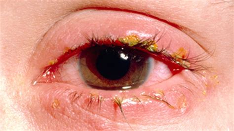 Blepharitis Dr Mark Harrison