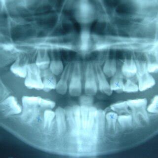 Bilateral mandibular second molar impaction showing excess space ...