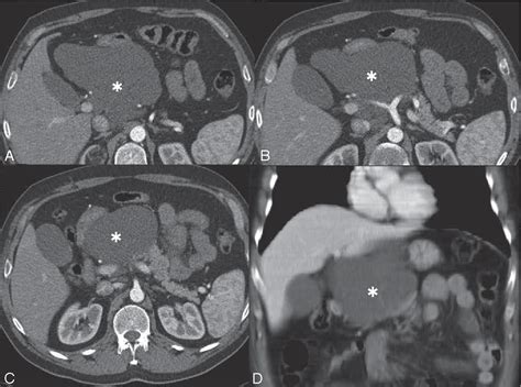 Figure 1 From Pancreatic Cystic Lymphangioma Diagnostic Approach With