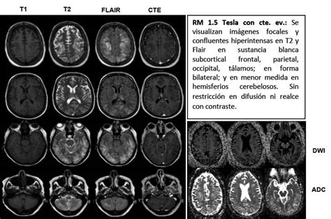 Leucoencefalopat A Posterior Reversible Diagn Stico Journal