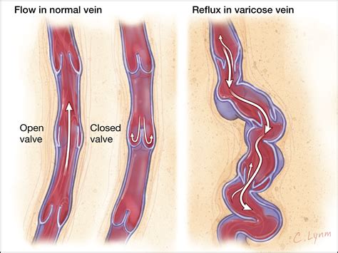 Management Of Varicose Veins And Venous Insufficiency Surgery Jama