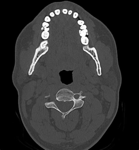 File:Petrous bone trauma - fracture, ossicular dislocation and ...