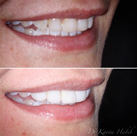 Composite Veneers Sydney Dental Bonding Sydney Dentist Ryde