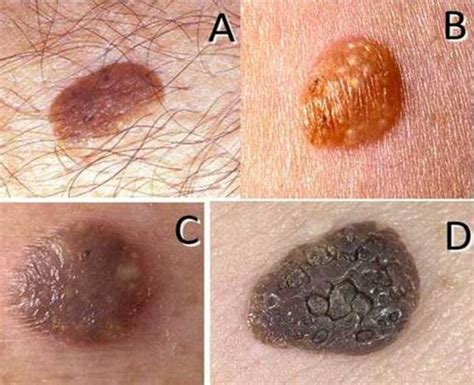 keratosis types - pictures, photos