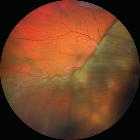 Choroidal Melanoma Fluorescein Angiography