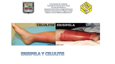 ERISIPELA Y CELULITIS Leonela Cordova Vena UDocz