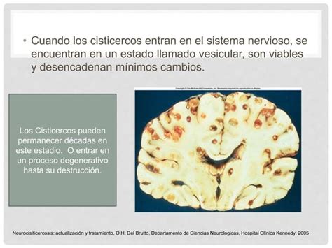 Cisticercosis Cerebral Ppt