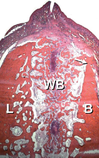 Figure From Dimensional Ridge Alterations Following Tooth Extraction