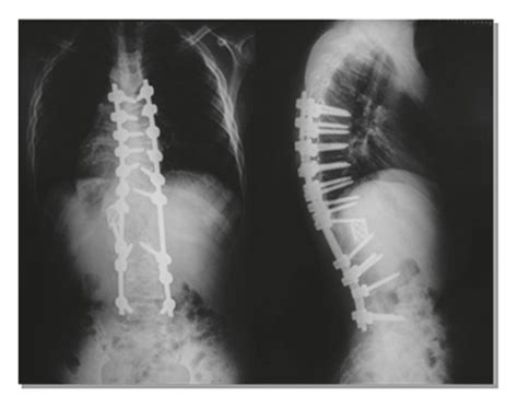 The Patient Was A 9 Years Old Boy With Lumbar Congenital Scoliosis A