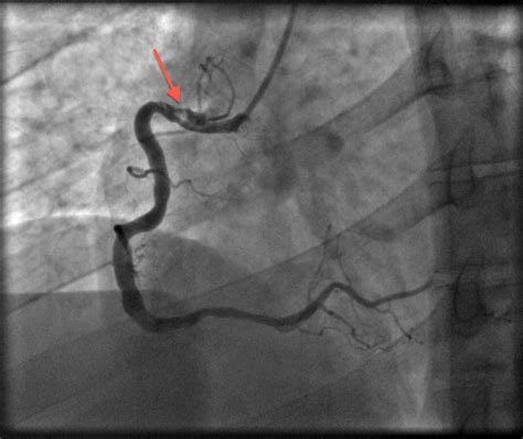 Spontaneous Coronary Artery Dissection A Complete Resolution With