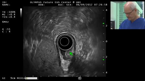 Eus Of A Submucosal Tumor In The Gastric Antrum Youtube