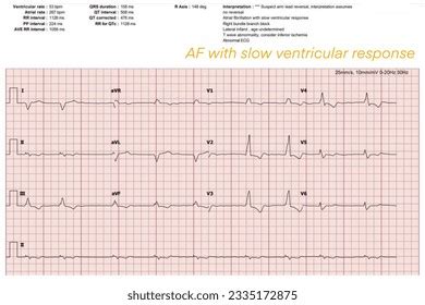 Differences Normal Ecg Waveform Each 12 Stock Vector Royalty Free