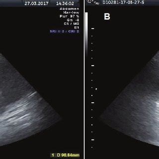 Ultrasound images of ascites. (A) Transabdominal ultrasound image ...